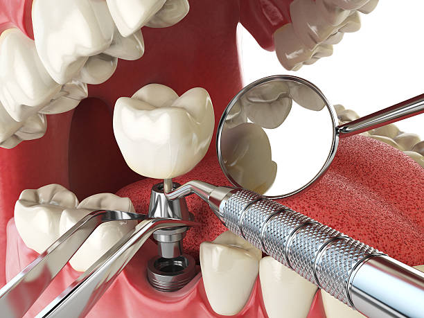 Best Dentist for Tooth Abscess  in Glendale, MS